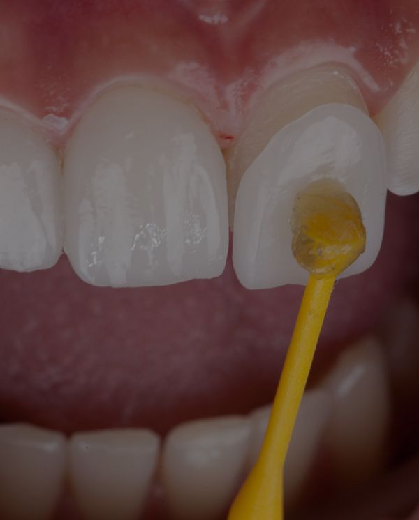 Treatment - Novo Dental Practice